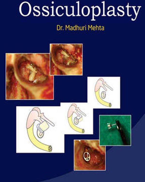 Atlas Of Ossiculoplasty