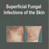 Superficial Fungal Infections of the Skin 