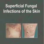 Superficial Fungal Infections of the Skin
