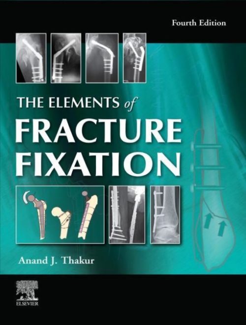 fracture