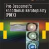 PRE-DESCEMET'S ENDOTHELIAL KERATOPLASTY(PDEK)