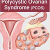 Decoding Polycystic Ovarian Syndrome (PCOS)