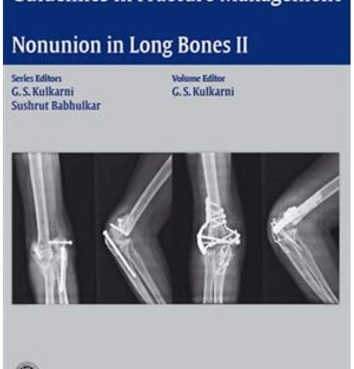 Nonunion in Long Bones-Part II 2016