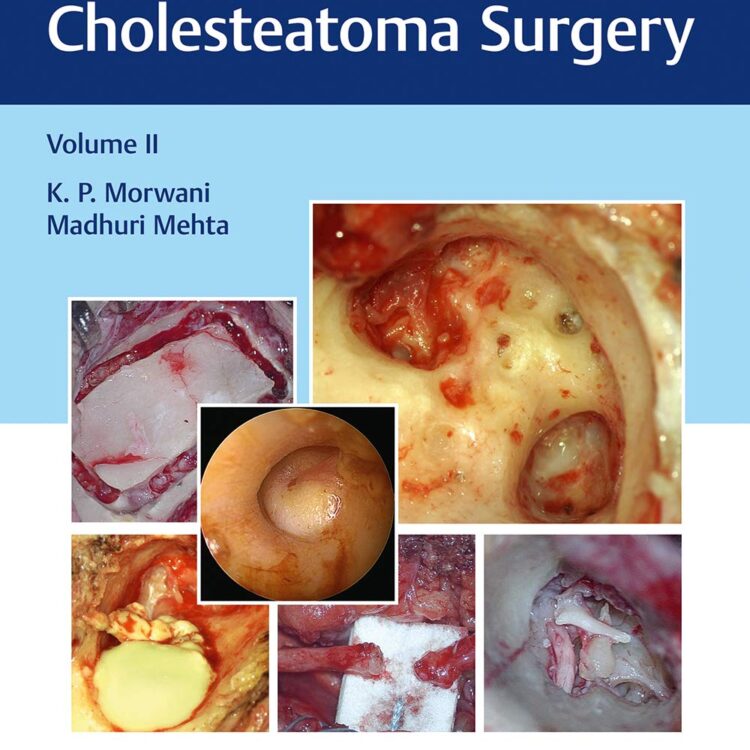 Atlas of Cavityless Cholesteatoma Surgery (Volume 2)
