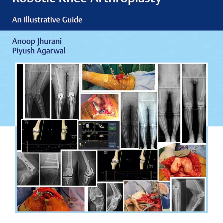 Computer Navigated and Hand Held Robotic Knee Arthroplasty: An Illustrative Guide, 1/e