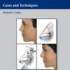 Rhinoplasty 1st Edition 2011