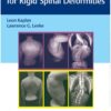 Corrective Osteotomies for Rigid Spinal Deformities 1st Edition 2023