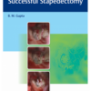 An Approach to Successful Stapedectomy 1st Edition 2021