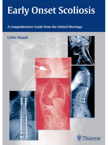 Early Onset Scoliosis A Comprehensive Guide from the Oxford Meetings 1st Edition 2015
