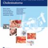 Microsurgical Management of Middle Ear and Petrous Bone Cholesteatoma 1st Edition 2019