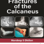 FRACTURES OF THE CALCANEUS