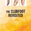 The Clubfoot Revisited