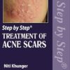 Step by Step Treatment of Acne Scars